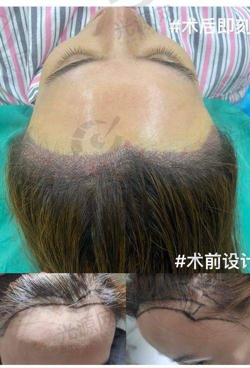 m发际线植发的实际实例