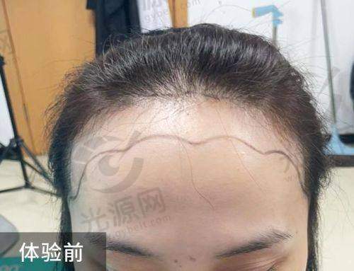 m发际线植发的潜在风险