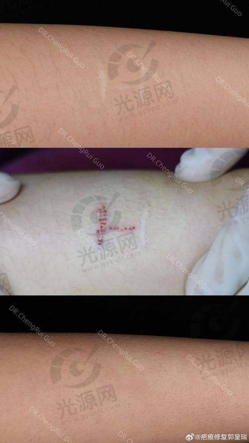 三、南宁疤痕整形项目收费情况