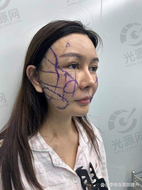 小切口macs面部提升术的维持时间