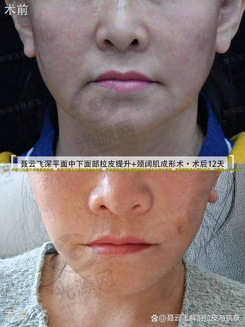 小切口macs面部提升术值得尝试吗？