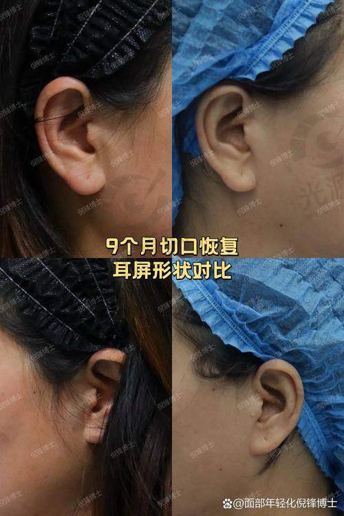 小切口macs面部提升术的切口位置