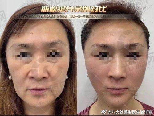 小切口macs面部提升术的切口位置、价格及维持时间揭秘，小切口macs面部提升术的费用通常从6万元起，效果如何值得尝试吗？