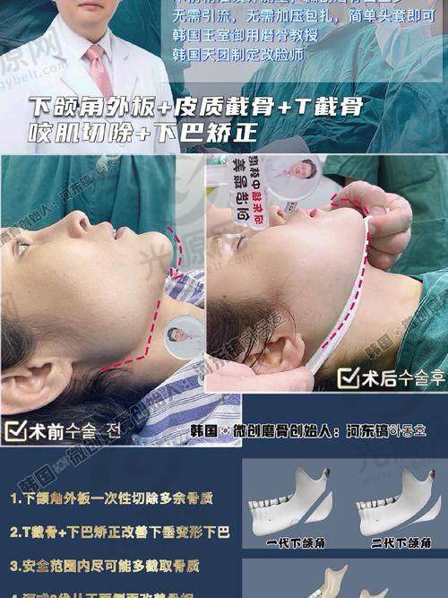 金一秀磨骨的收费情况