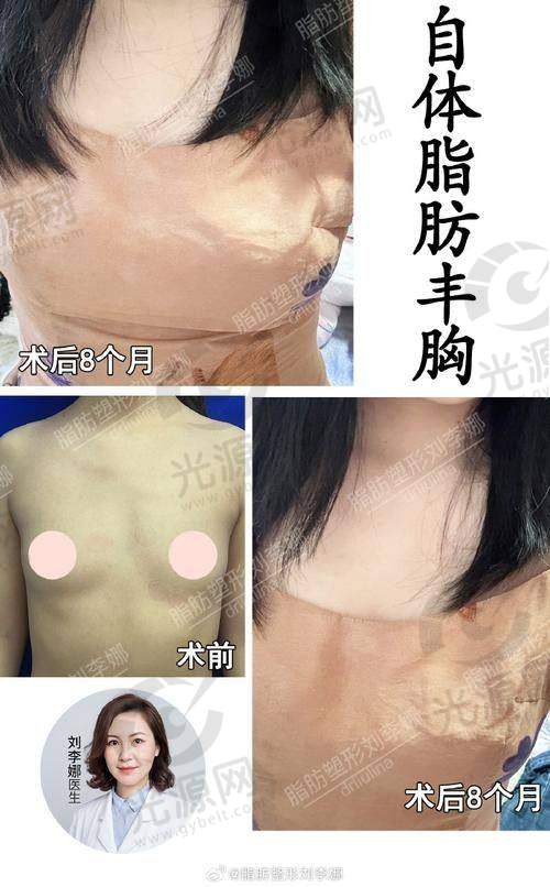 假体250cc适合的个体特征