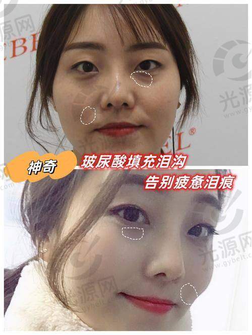 填充泪沟的实际实例分析