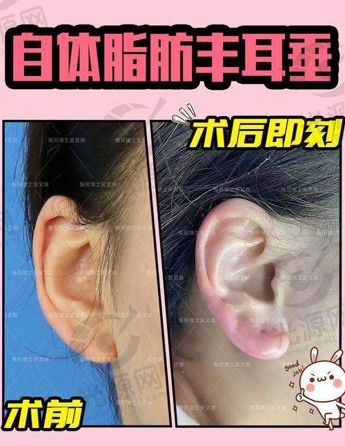 二、郑州大学第二附属医院垂耳整形的技术优势