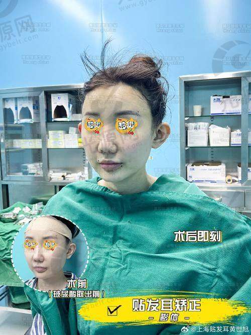 一、郑州大学第二附属医院专精的垂耳整形术