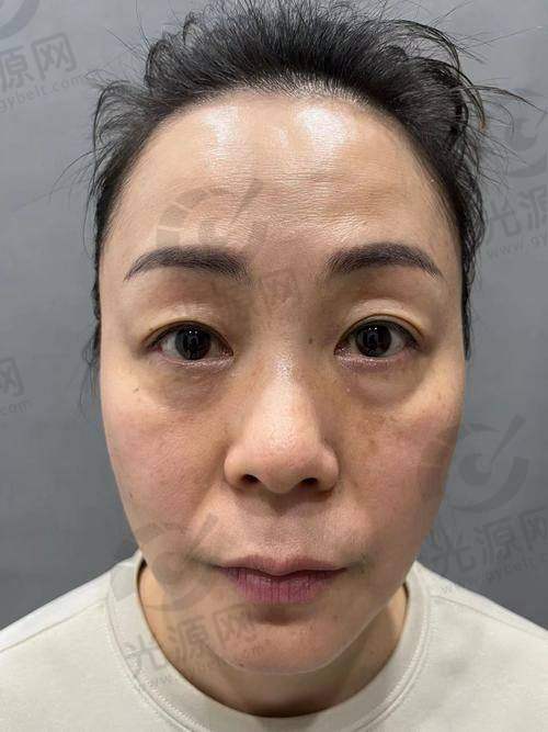 四、哈尔滨眼袋手术费用情况