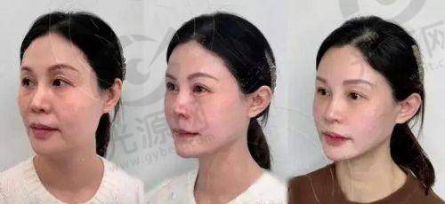 口角囊带实际实例分析