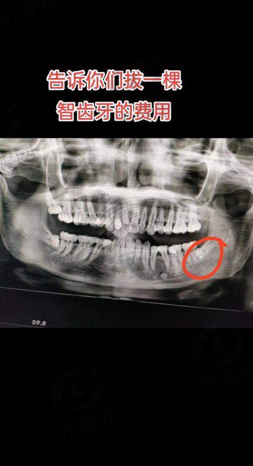结论：智齿拔牙后窟窿修复图所传达的重要信息