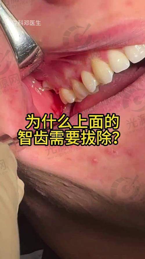 智齿拔牙后的护理与注意事项