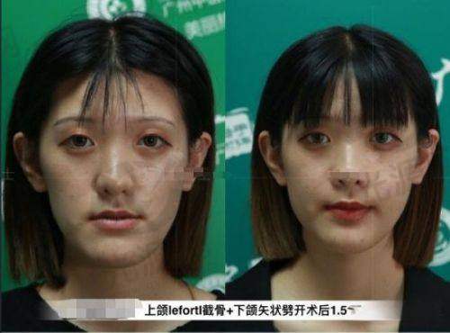 朝阳二院美容科自体脂肪填充项目价格