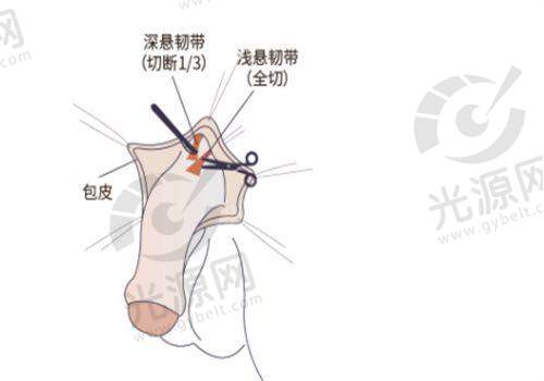 北京加减美医疗美容大拉皮询问与预约