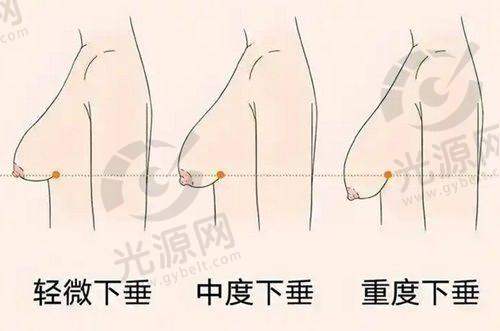北京黄寺医院吸脂价格及医生介绍