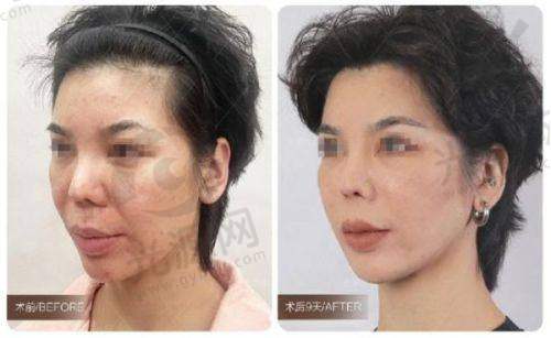 选择穆宝安医生做拉皮手术的理由