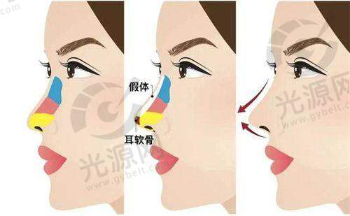脂肪整形项目