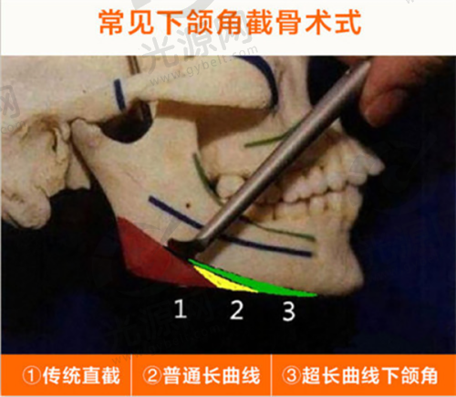 北京加减美面部提升价格表汇总
