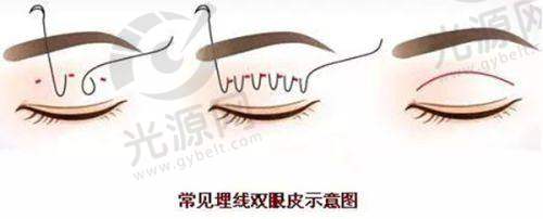 杜太超医生手术的价格详情