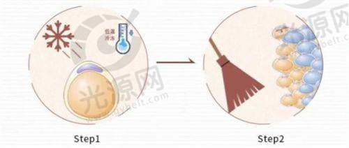 隆鼻手术情况