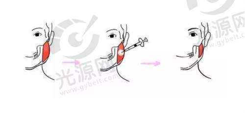 鼻部整形项目