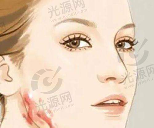 大拉皮手术技术亮点:实现面部年轻化