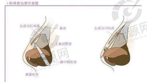 如何选择适合自己的大拉皮医生