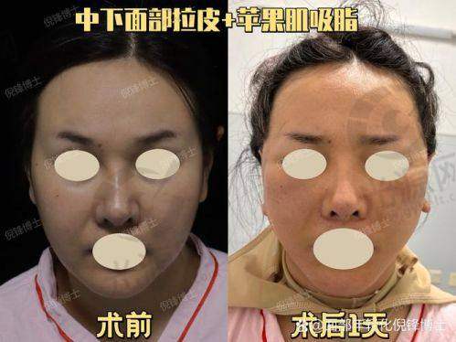 穆宝安大拉皮手术的优势对比