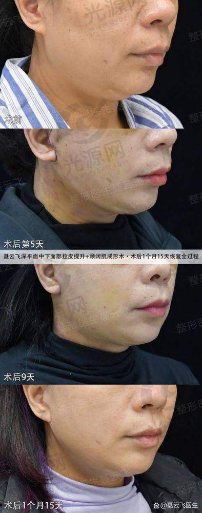 北京加减美医疗美容穆宝安简介：国内面部提升佼佼者，V6/V9技术重塑年轻容颜 