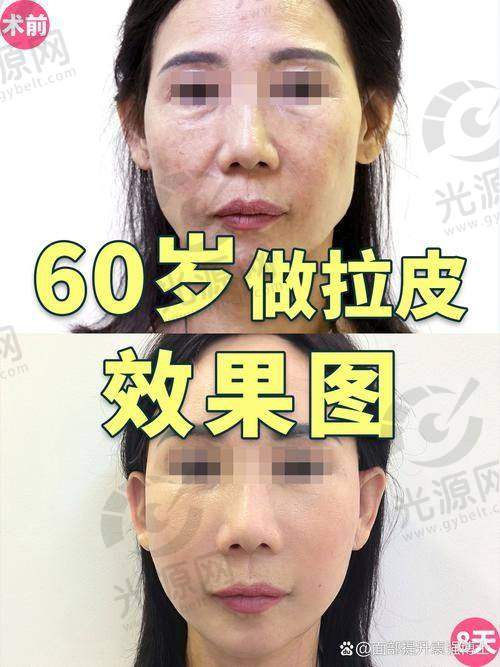 穆宝安面部提升手术的价格与实例
