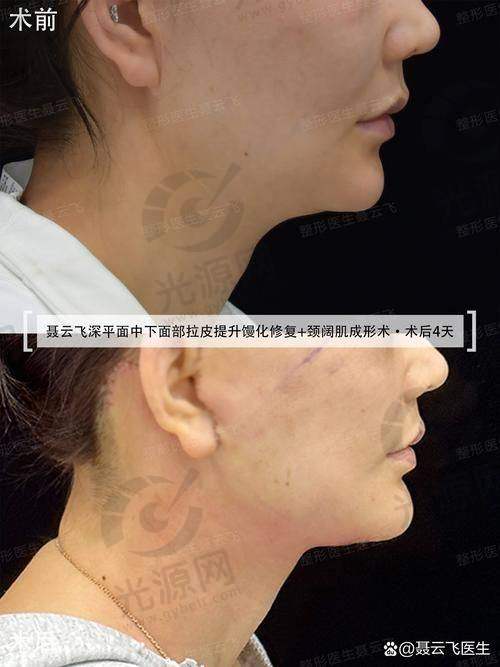 北京加减美穆宝安大拉皮野生案例曝光！技术优效果好，抗衰难题轻松解决 
