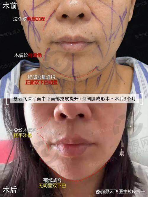 北京加减美穆宝安口碑爆棚！技术优势多效果持久，患者实例见证高超医术 