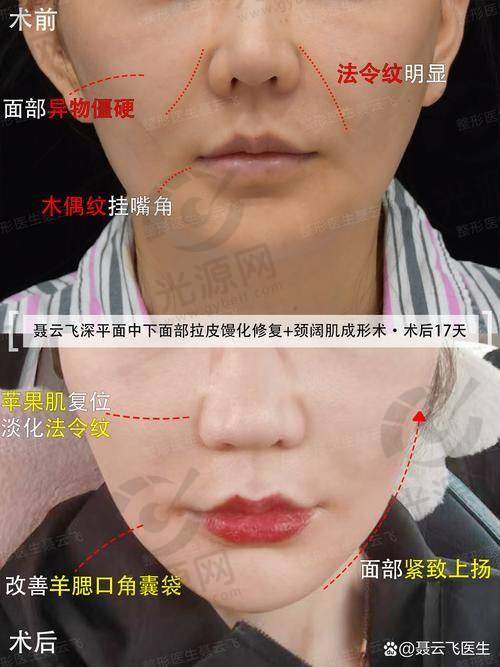 北京加减美医疗美容的面部提升项目价格参考