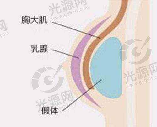 膨体隆鼻排异的症状与免疫系统反应