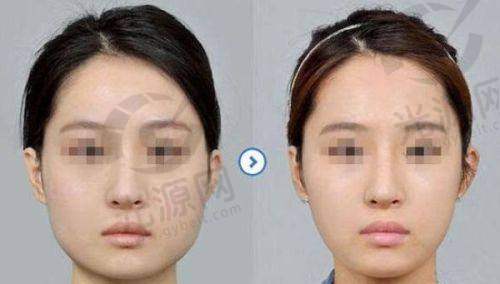 实例一:王女士的阴唇漂红体验