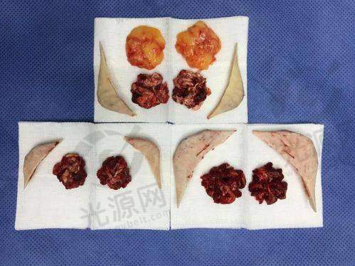 徐威强医生颧骨手术的真实实例