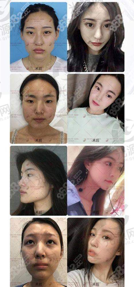 徐威强医生的磨骨技术