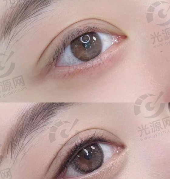 处女膜修复手术价格