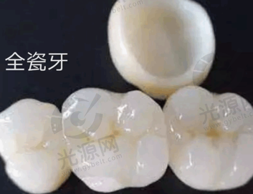 美晶瓷全瓷牙与爱尔创全瓷牙对比分析：材质、价格与美观度哪个更优？