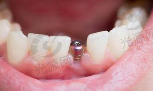纽百特与登特斯的适用人群