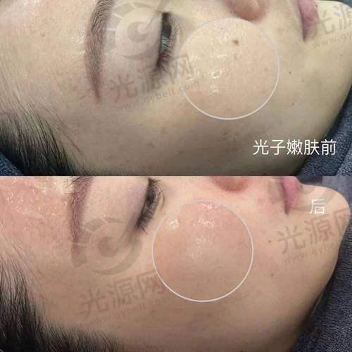 结论：光子嫩肤与色素沉淀的正确认识