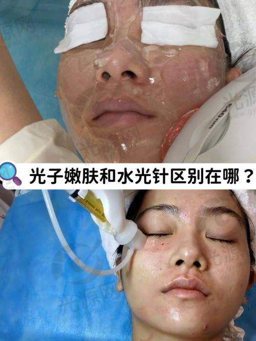 光子嫩肤后的成效与期望