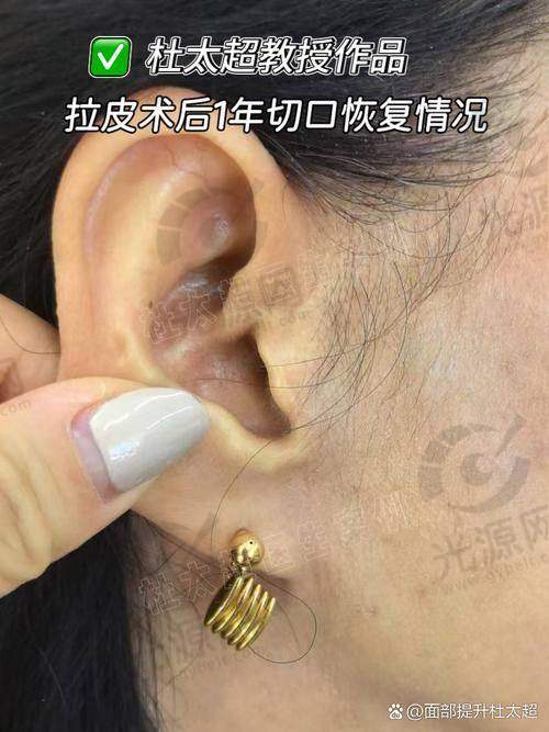 v 美减龄面部提升适应人群