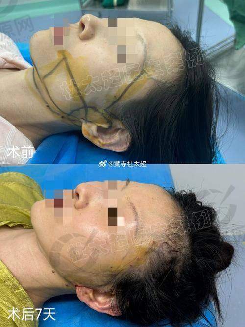 想实现面部年轻化？北京加减美穆宝安医生了解下，附穆宝安联系电话 