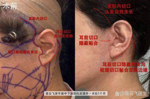 北京加减美医院助力穆宝安大拉皮手术