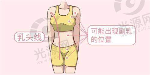 牙套种类