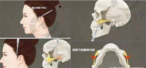 北京纯脂冯斌医生:脂肪移植领域的领军人物