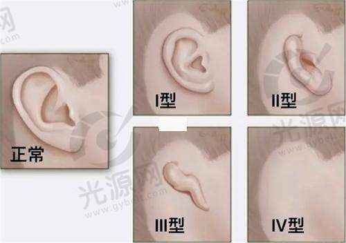 毛发种植项目类型