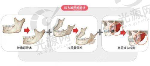 锦州医科大学附属第一医院医学美容科多项医美价格曝光，双眼皮、瘦脸、美白等都有！
