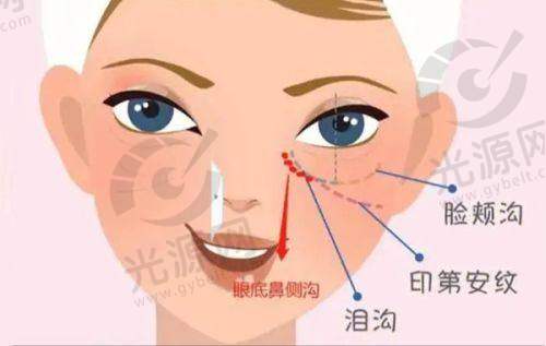 热门眼部整形项目